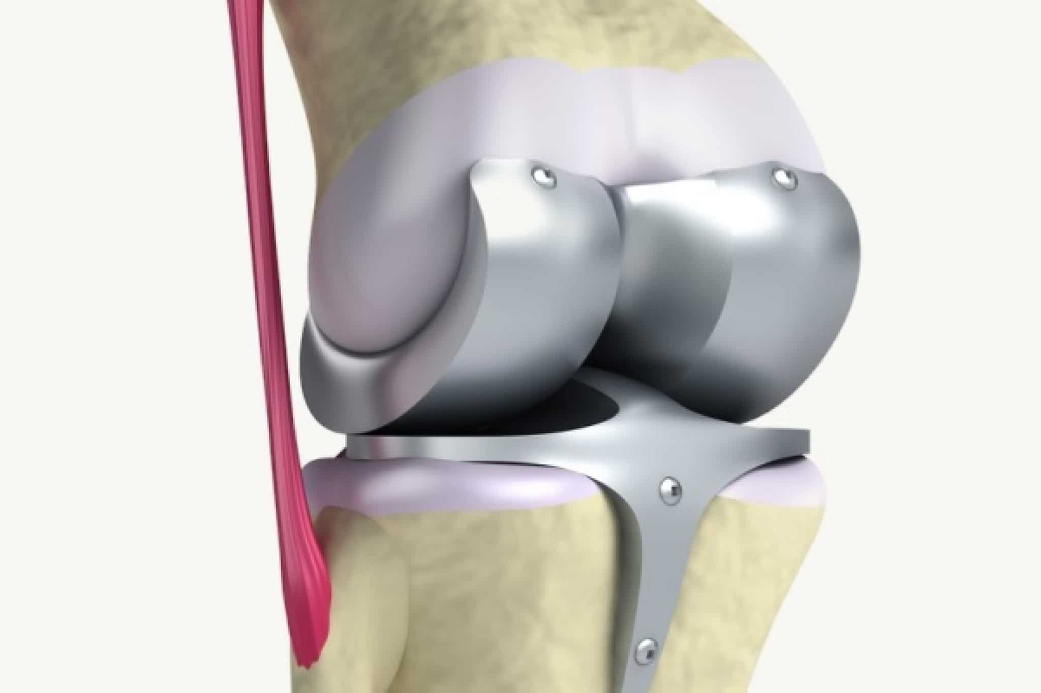 Операции на коленном суставе стоимость. Эндопротез мениска коленного сустава. Артроз коленного сустава эндопротез. Тазобедренный эндопротез Райт. Резекция медиального мениска.
